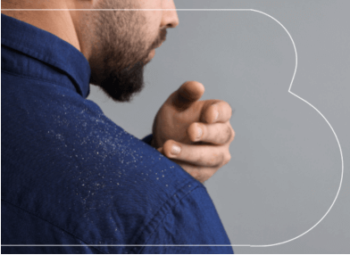 Pellicules : causes, solutions et astuces pour s’en débarrasser